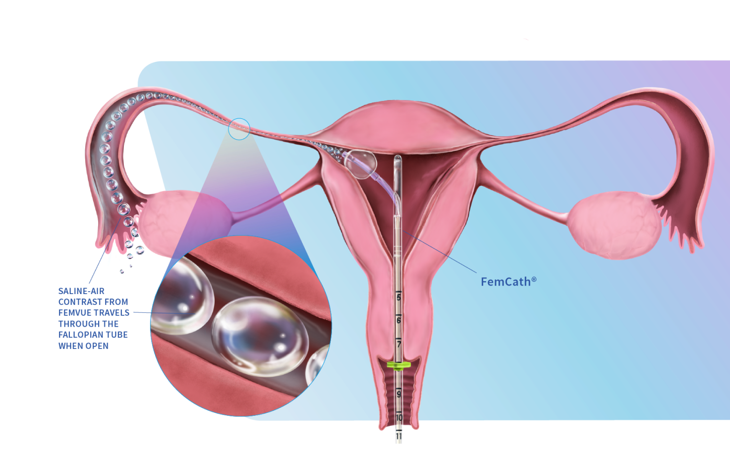 Mechanism of action showing FemVue with FemCath.