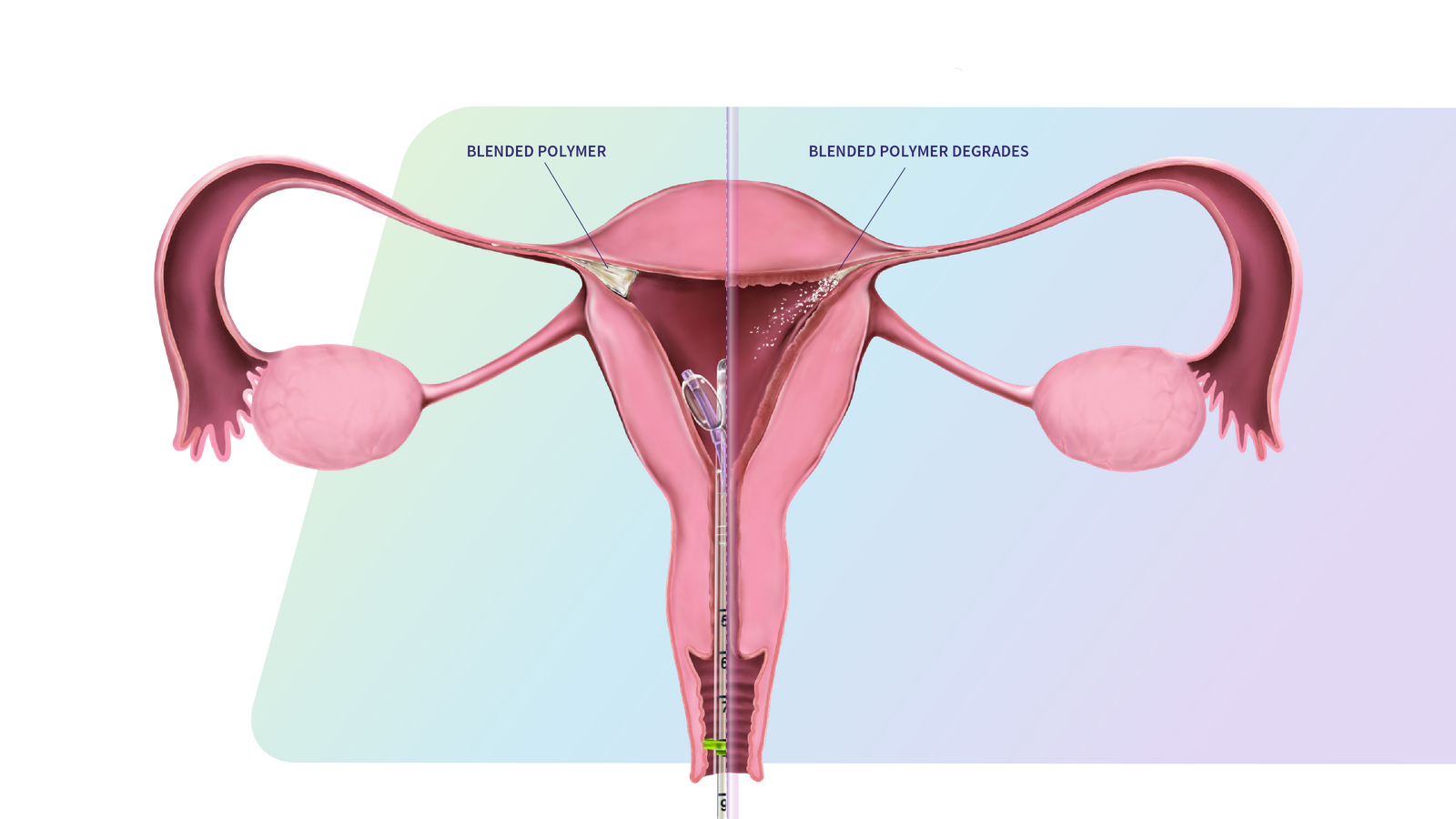 Image of cross section of uterus demonstrating Blended Polymer transforming and leaving the body